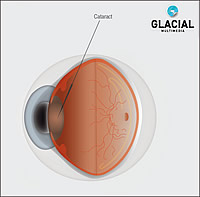 cataract_anatomy