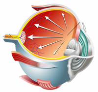 glaucoma-1